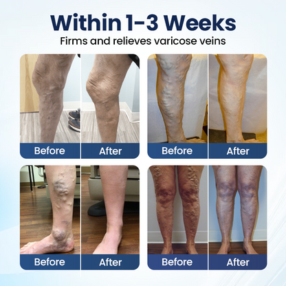 Timilk® Deep Vein Repair Microneedle Patch(A)