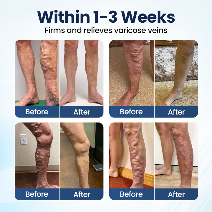 Timilk® Deep Vein Repair Microneedle Patch(A)