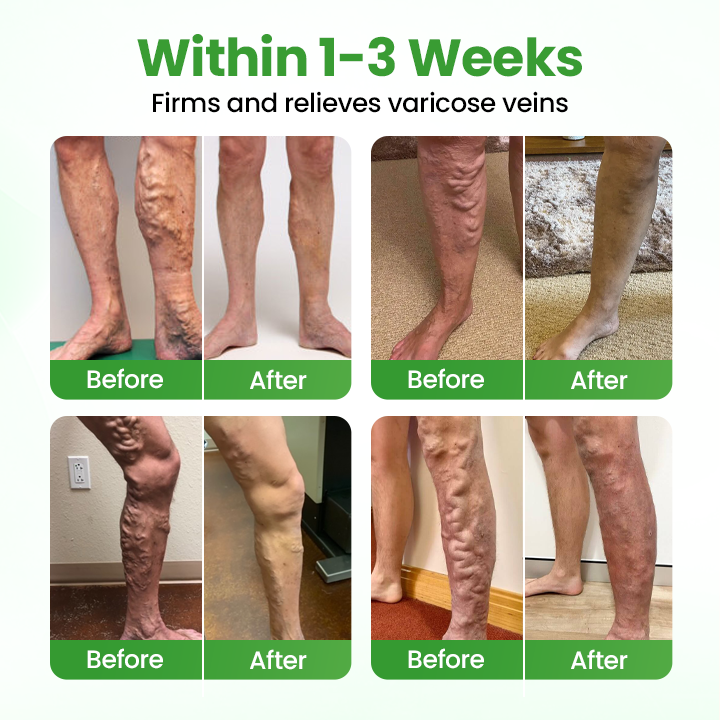 Healrize® VeinHeal Microneedle Patch,