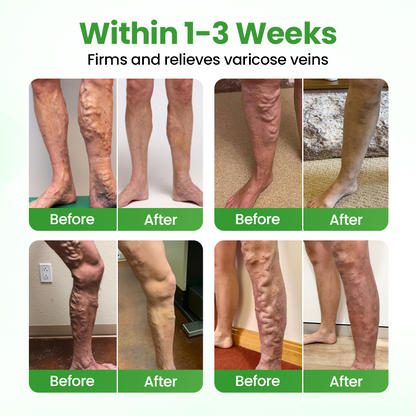 Healrize® VeinHeal Microneedle Patch,