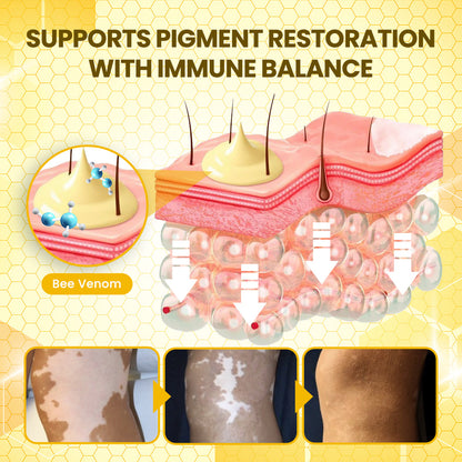 Timilk® NaturaViti Bee Venom Vitiligo Cream（A)