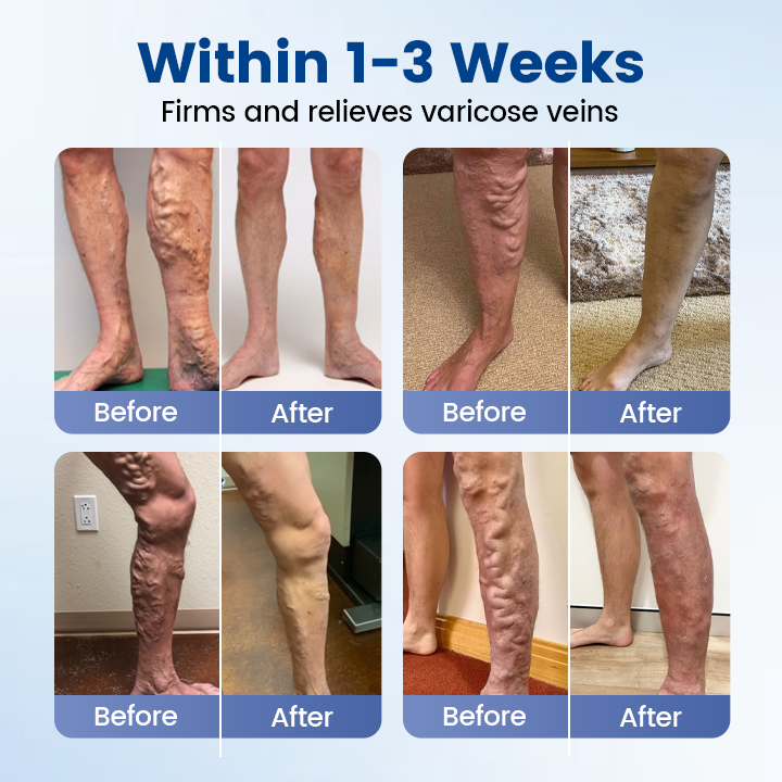 Timilk® Vein Ease Microneedle Therapy Patch - Fast ⚡Effective 💪 and Non-Invasive 🚫 Treatment for Varicose Veins & Leg Swelling 👣(A)