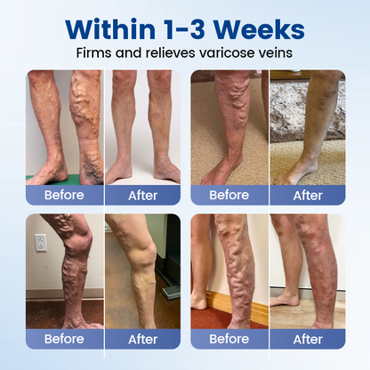 Timilk® Vein Ease Microneedle Therapy Patch - Fast ⚡Effective 💪 and Non-Invasive 🚫 Treatment for Varicose Veins & Leg Swelling 👣(A)