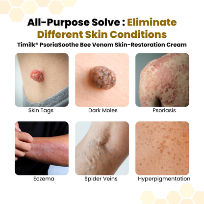 Timilk® PsoriaSoothe Bee Venom Skin-Restoration Cream(A)