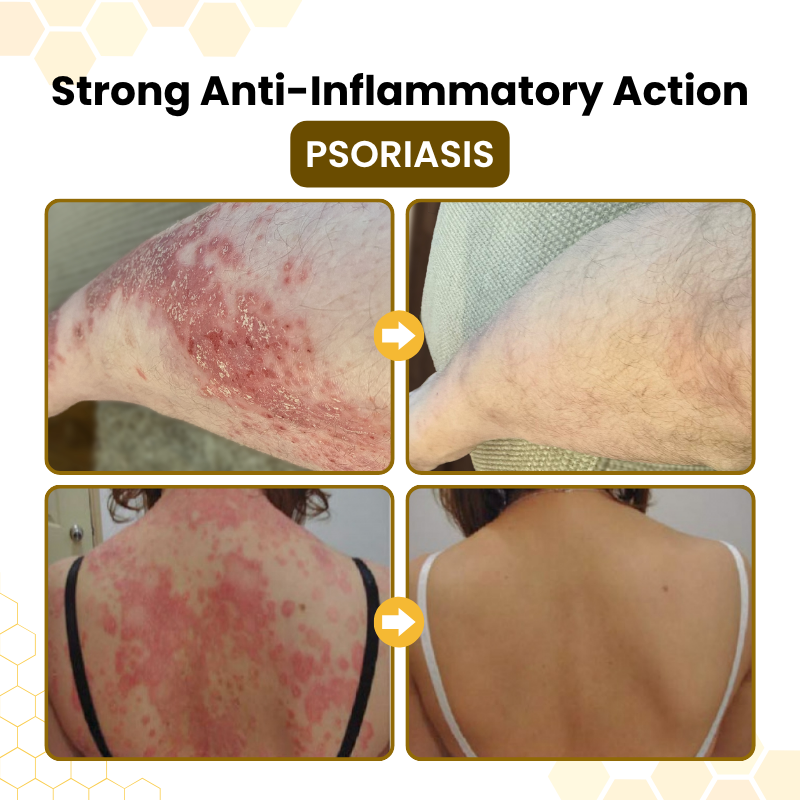 Timilk® PsoriaSoothe Bee Venom Skin-Restoration Cream(A)