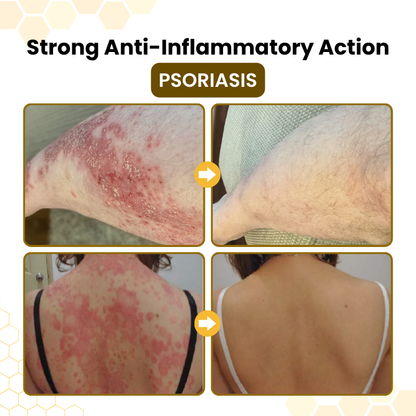 Timilk® PsoriaSoothe Bee Venom Skin-Restoration Cream(A)