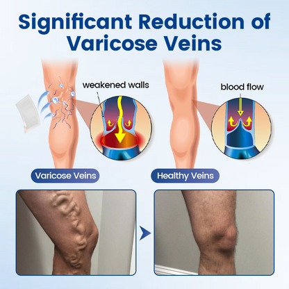Timilk® Vein Ease Microneedle Therapy Patch - Fast ⚡Effective 💪 and Non-Invasive 🚫 Treatment for Varicose Veins & Leg Swelling 👣(A)