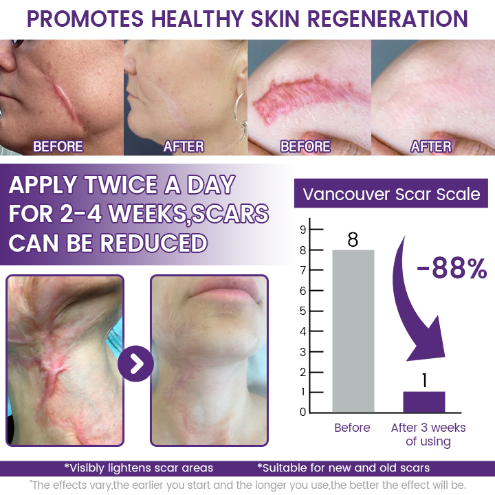 Timilk® ReGenScar Stem Cell Scar Gel (A)