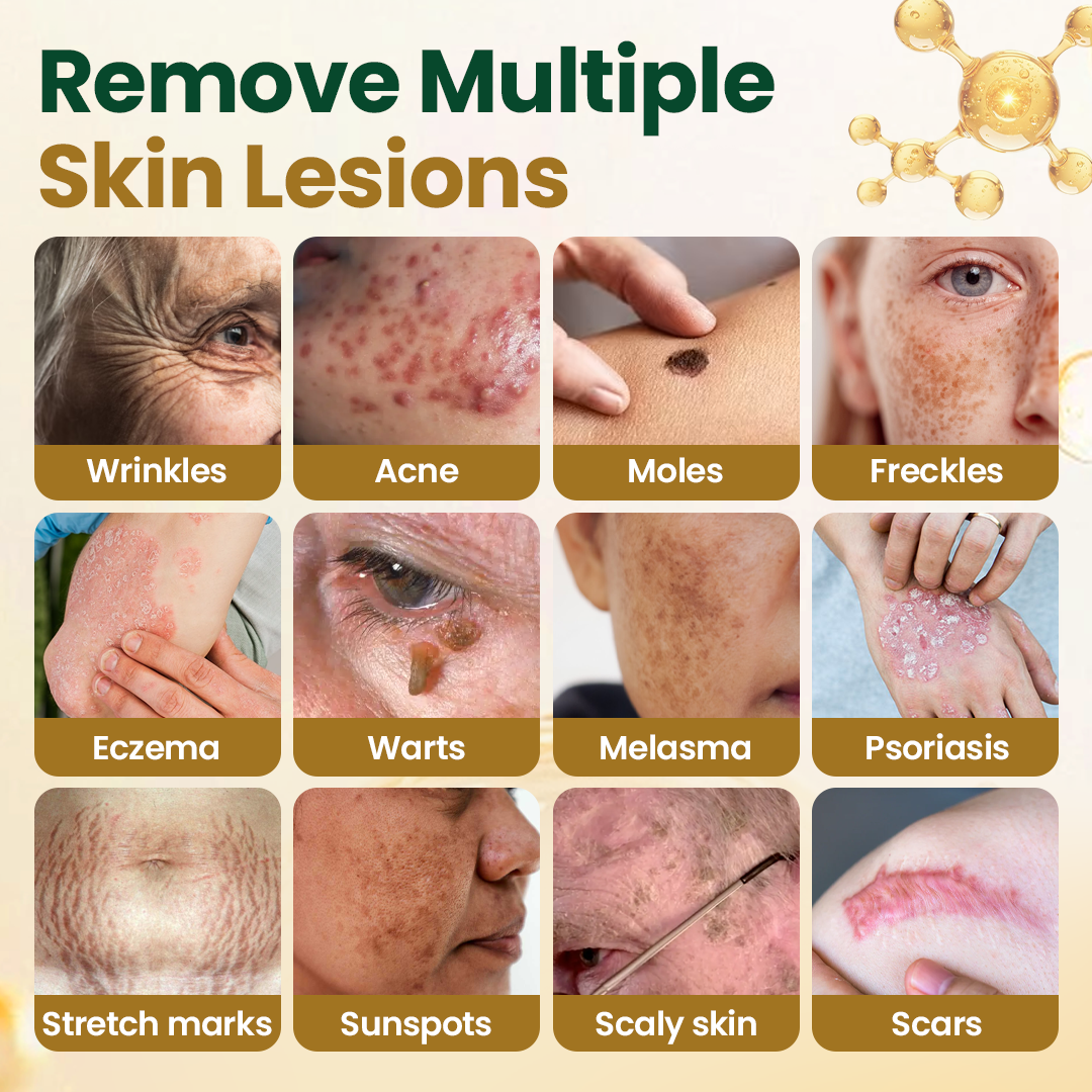 Timilk® Wart Remover Cream with Bee Venom and Salicylic Acid – Skin Tag Removal & Skin Repair Formula for Face and Body🔥（A）
