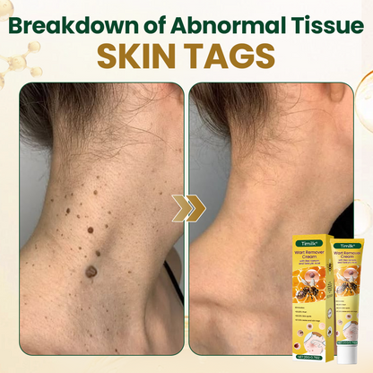 Timilk® Wart Remover Cream with Bee Venom and Salicylic Acid – Skin Tag Removal & Skin Repair Formula for Face and Body🔥（A）