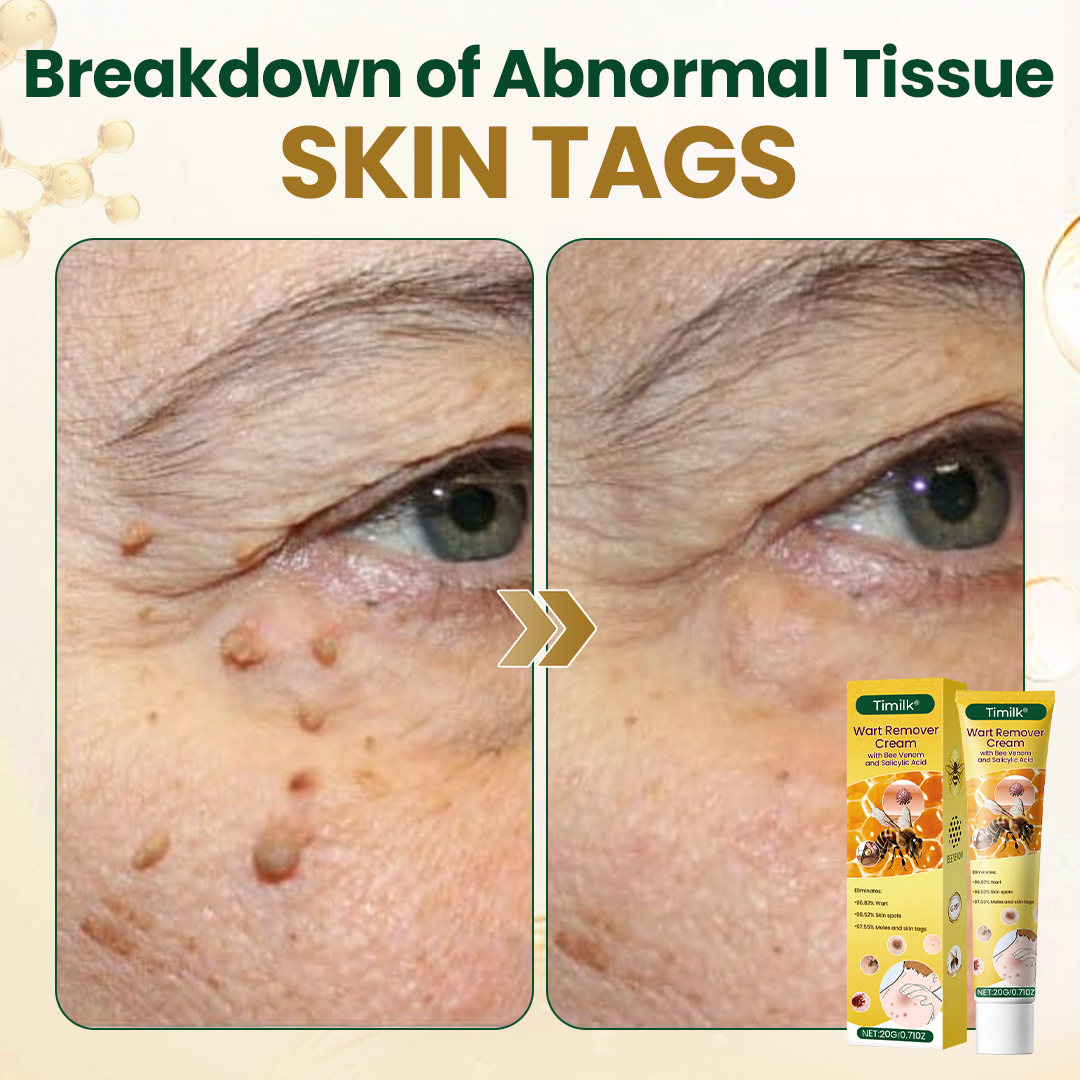 Timilk® Wart Remover Cream with Bee Venom and Salicylic Acid – Skin Tag Removal & Skin Repair Formula for Face and Body🔥（A）