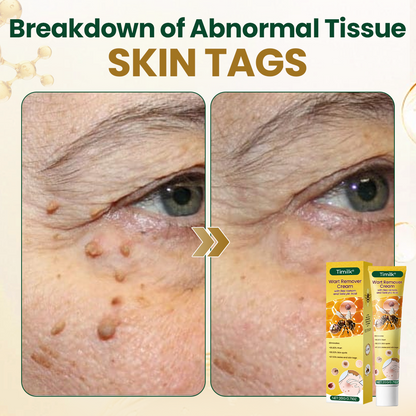 Timilk® Wart Remover Cream with Bee Venom and Salicylic Acid – Skin Tag Removal & Skin Repair Formula for Face and Body🔥（A）