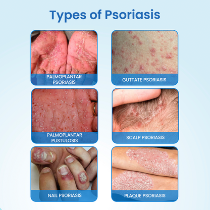 Timilk® MagnesiumHerb Psoriasis Relief Cream(A)
